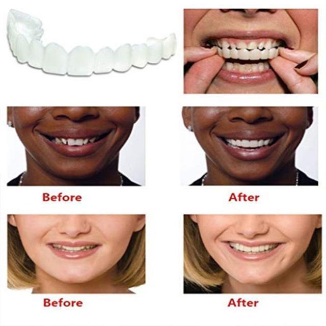 MYSMILE™: Revolutionary Veneer for an Attractive Smile