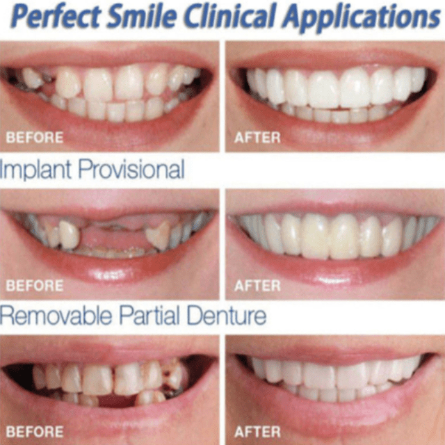 MYSMILE™: Revolutionary Veneer for an Attractive Smile