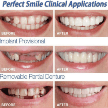 MYSMILE™: Revolutionary Veneer for an Attractive Smile