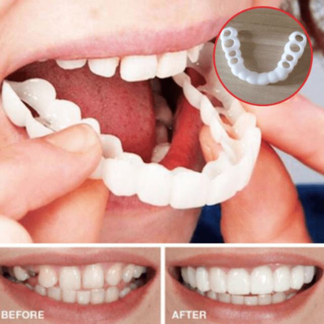 MYSMILE™: Revolutionary Veneer for an Attractive Smile