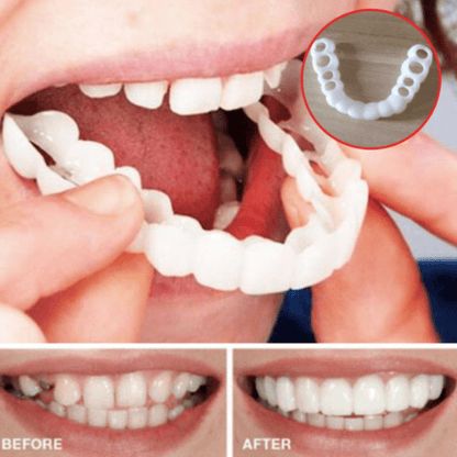 MYSMILE™: Revolutionary Veneer for an Attractive Smile