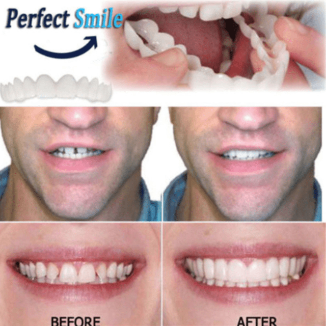 MYSMILE™: Revolutionary Veneer for an Attractive Smile